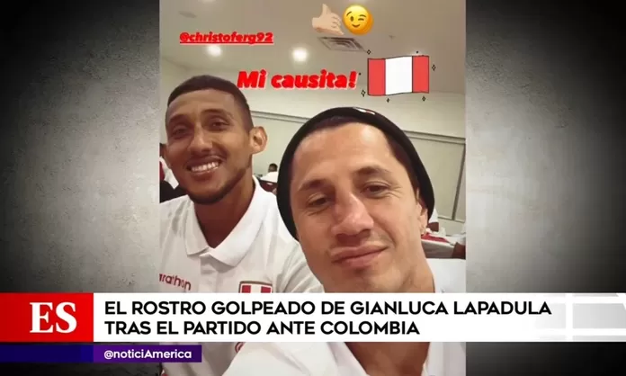 Gianluca Lapadula La impactante imagen de cómo quedó su nariz tras