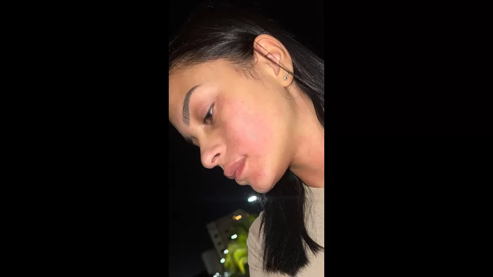 Isabella Ribeiro mostró en Instagram cómo quedó su rostro tras agresión. | Fuente: @isabellarbf
