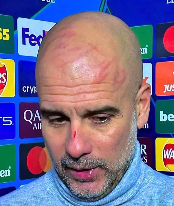 Guardiola admitió que se realizó las heridas en la cara por impotencia. | Foto: X