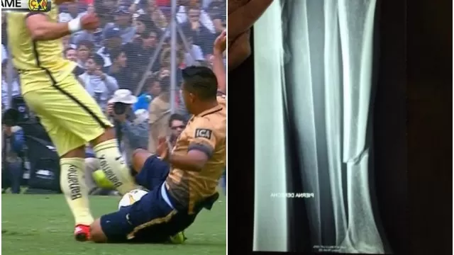 Javier Güemez del América sufrió escalofriante fractura ante Pumas