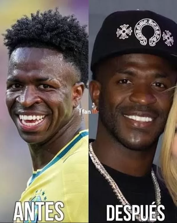 Vinicius Junior Se Oper La Cara Armonizaci n De Ment n Para El Crack 
