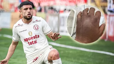 Jean Ferrari protestó por cómo quedó la mano de Rodrigo Ureña tras el duelo con Sport Boys del domingo. | Composición AD Jean Ferrari protestó por cómo quedó la mano de Rodrigo Ureña tras el duelo con Sport Boys del domingo. | Composición AD