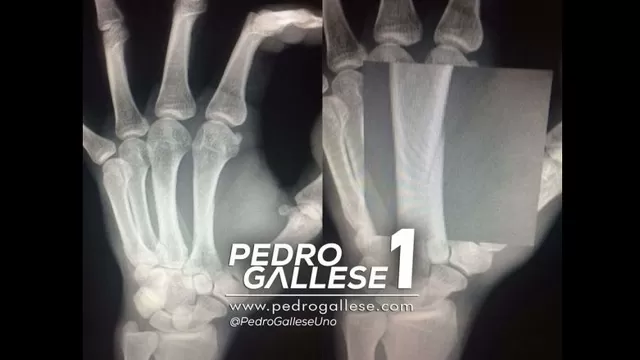 Pedro Gallese sufrió fractura y será baja cuatro semanas en Veracruz-foto-2