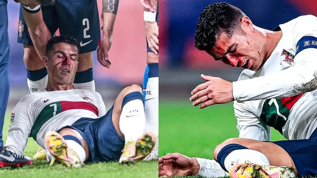 Cristiano sufrió un golpe en el rostro. | Video: Espn